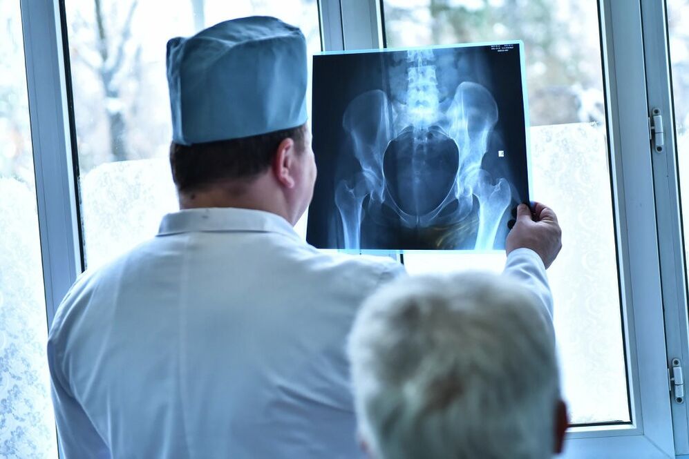 El médico observa una imagen de una articulación de cadera con artrosis.